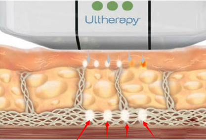 New Technology 3d Hifu Face Lifting New Technology 3d Hifu Face Lifting